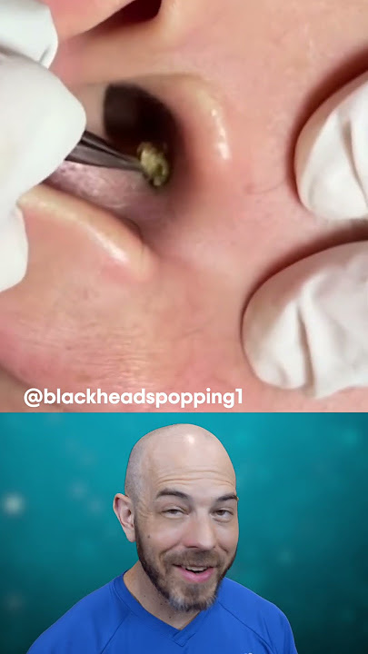 This HUGE ear blackhead removal is super satisfying🤩 (credit:@blackheadspopping1 on TT) #blackhead