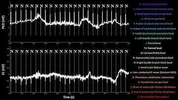 Electrocardiogram MIT-BIH Arrhythmia Database N°101 with tag anotations