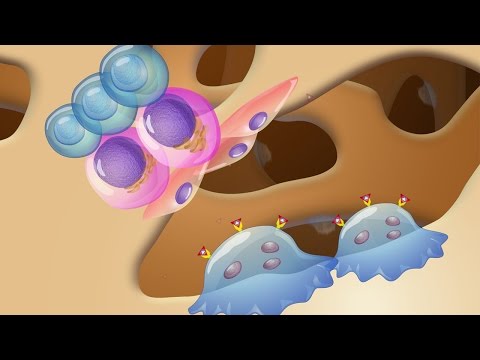 Pathogenesis and Treatment of Myeloma Bone Disease