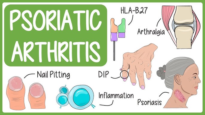 Psoriatic arthritis (PsA) is a chronic autoimmune condition that combines joint inflammation with psoriasis, a skin disorder characterized by scaly, red patches. It affects approximately 30% of people with psoriasis and can lead to joint damage if untreated18.