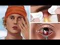 ASMR Help Justin Bieber Remove thick outer and inner stye | Satisfying video by WOW Brain Kr