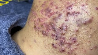 Forbidden Relief: 60-Minute Non-Stop Deep Rooted Blackhead Extraction Today