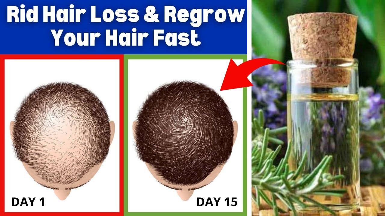 7 Home Remedies to Prevent Hair Loss and Regrow Your Hair Faster - YouTube