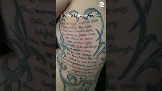 Before & After 11 Tattoo Removal Treatments at Removery!🤩