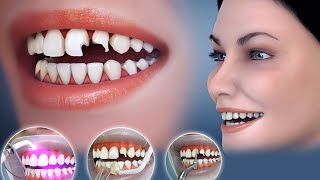 AWESOME Installation of  Veneers | Cosmetic Dentistry