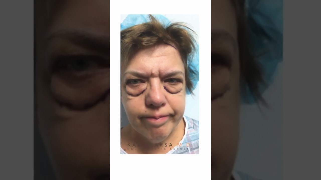 Upper and Lower Blepharoplasty with Dr. Kami Parsa | Hooded Upper Eyelids and Puffy Lower Eye Bags