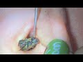 ASMR耳掃除: 耳垢耳掃除耳垢除去 | 耳かき 5