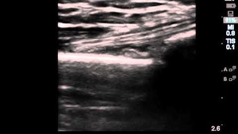 Distal Radius Fracture with Bedside Ultrasound