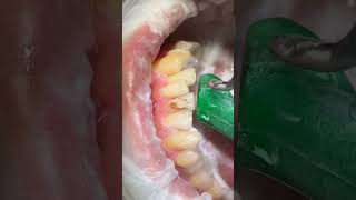 ازالة تصبغات الاسنان dentalhygiene dr_abdullah_sultan_dentist dentist orthodontics dental