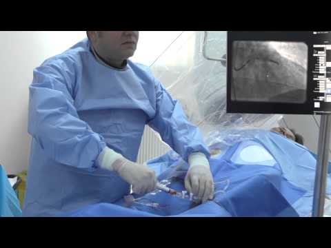 Video: Angioplastia Cardiacă și Plasarea Stentului