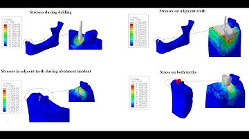 Modelling effect of Titanium/gold implants on the adjacent teeth