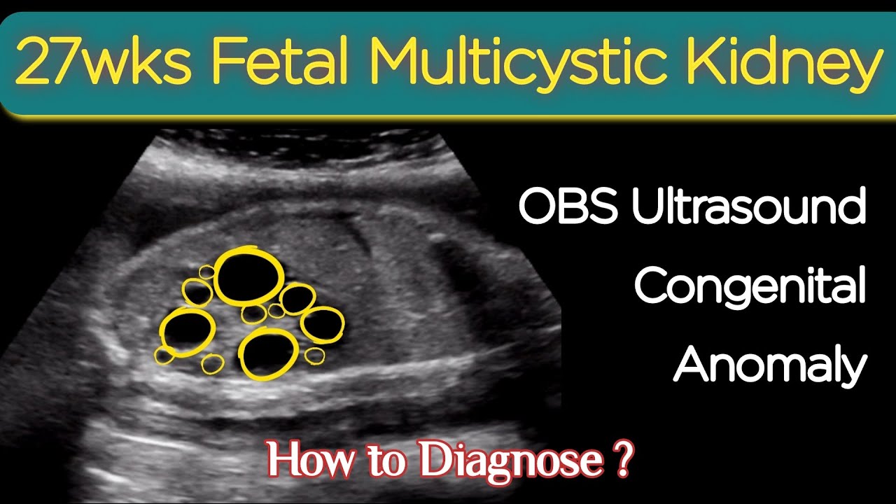 27wks Fetal Multicystic Kidney OBS Ultrasound Congenital Anomalies