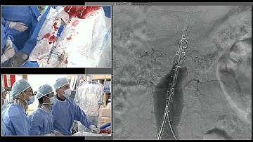 TCTAP 2015 Endovascular Live Case Session V. AAA Intervention