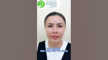 Xóa rãnh cười bằng filler , Quy trình tiêm filler xóa rãnh cười ? Filler nào tốt để xóa rãnh cười ?