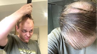 BALDING Man SHAVES Off His Biggest INSECURITY