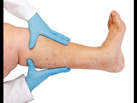 symptoms-of-varicose-veins,-how-to-get-rid-of-varicose-veins-on-legs,-spider-veins-pregnancy