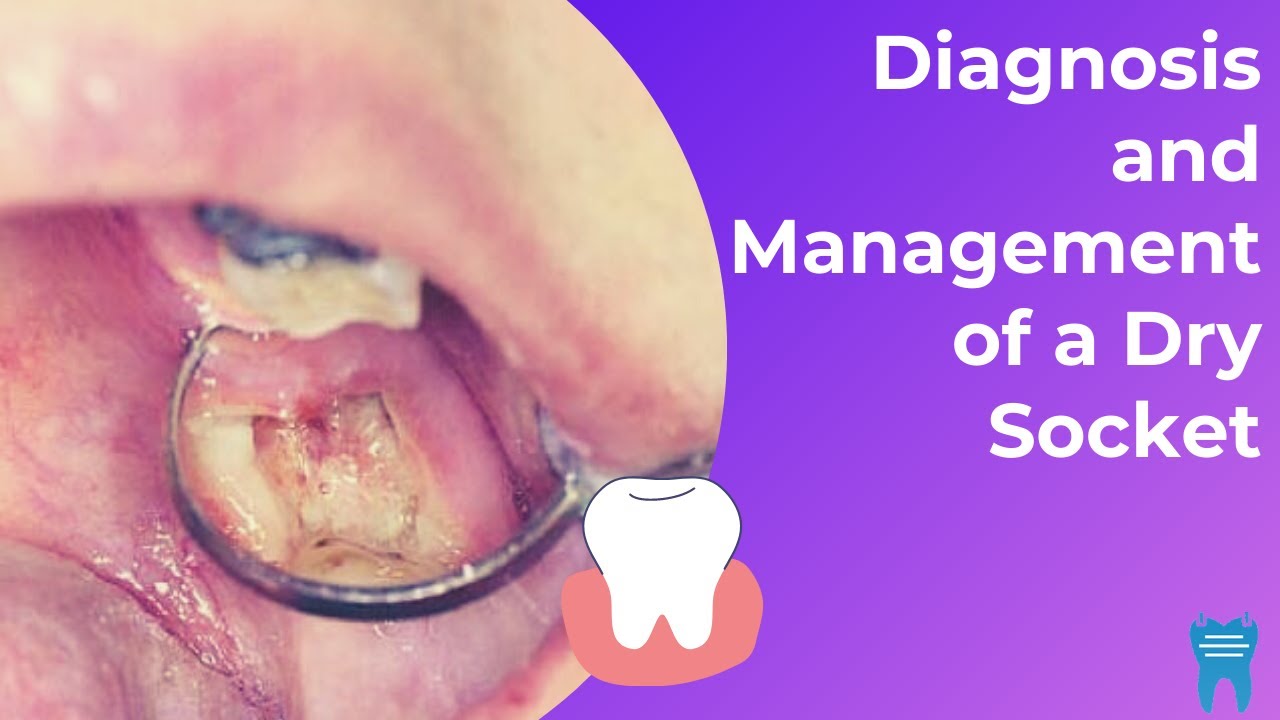 What is a Dry Socket?  Diagnosis and Management 