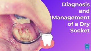 What is a Dry Socket? | Diagnosis and Management