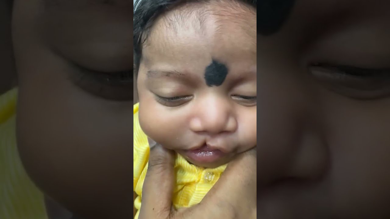 Microform cleft lip and incomplete cleft   palate of the soft palate