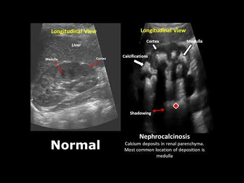 Kidney, Ureter and Bladder (KUB) Ultrasound Normal Vs Abnormal Image Appearances Comparison