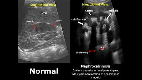 Kidney, Ureter and Bladder (KUB) Ultrasound Normal Vs Abnormal Image Appearances Comparison - DayDayNews