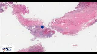 Ovary: Endometriotic cyst Microscopy - Talking slide