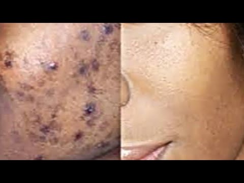 How to Clear/Clean out Acne Holes/Acne/Pimples Treatment/Remedy