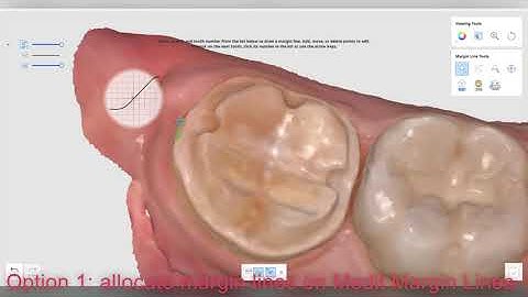 Same day 3D printed "crown-lay" with Clinux and Rodin Sculpture