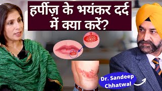 Herpesshingles हरपज यन शगलस ह जय त कय कर कय नह, दरद स कस पय छटकर?