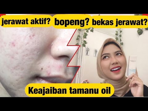 Review Tamanu Oil Untuk Bekas Jerawat Dan Bopeng Youtube