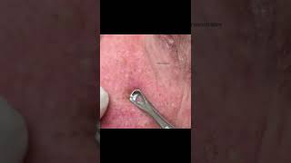 Extreme Solar Comedone Extraction