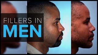 Fillers in Men