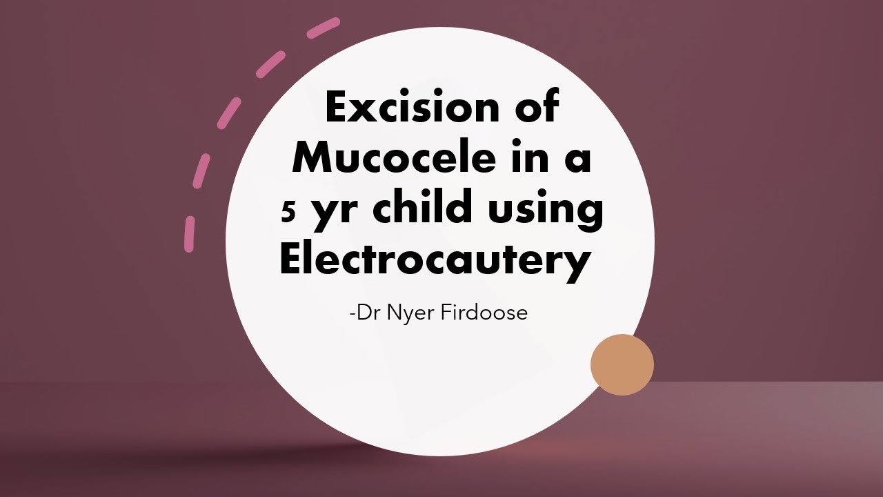 Mucocele Excision Using Electro-Cautery in a 5 yr child- Dr Nyer ...