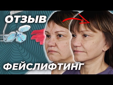 Отзыв. Фейслифтинг. Хирург Блохин С.Н.