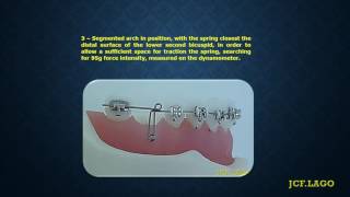 SEGMENTED ARCH FOR THE LOWER SECOND MOLAR TRACTION