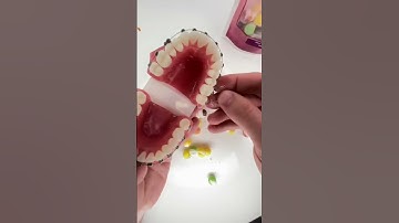 Thử thách ăn kẹo không làm bung mắc cài cùng Dr Ngọc Yến. #niềng_răng #niengrangmaccai