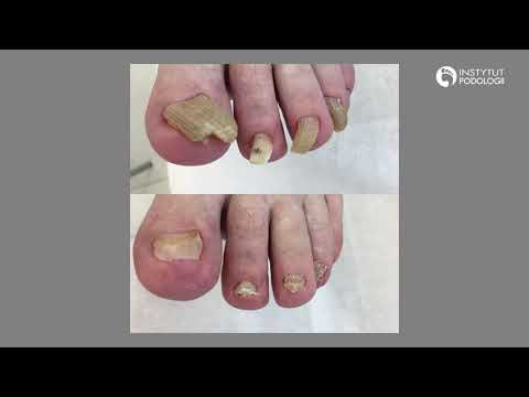 Instytut Podologii - grzybica paznokci, leczenie