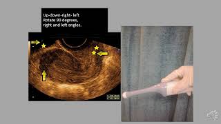 For beginners :TVS - Probe movements and ultrasound picture orientation