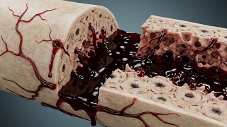How a Broken Bone Heals Itself — The 3D Repair Process