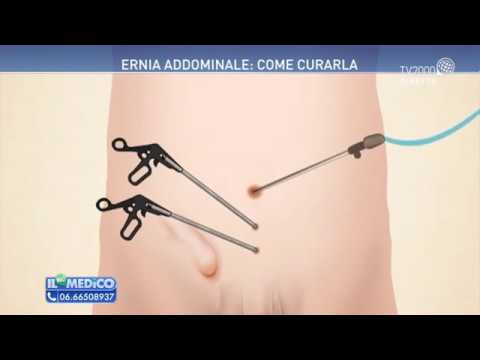 Video: Come riparare l'ernia spigeliana?