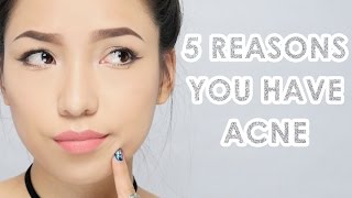 5 Reasons You have Acne & How To Get Rid Of Them