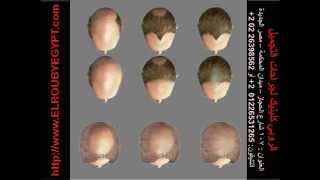 زراعة الشعر للسيدات #جراحة_تجميل