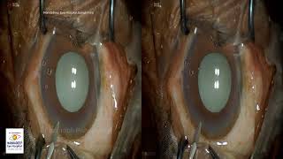White cataract Dr Sourabh Patwardhan Live Cataract surgery. For training 7028402375 Luxor Revalia