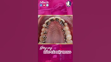 🌟 𝐍𝐢𝐞̂̀𝐧𝐠 𝐫𝐚̆𝐧𝐠 𝐦𝐚̆́𝐜 𝐜𝐚̀𝐢 𝐦𝐚̣̆𝐭 𝐭𝐫𝐨𝐧𝐠 – 𝐓𝐮̛̣ 𝐭𝐢𝐧 𝐯𝐨̛́𝐢 𝐧𝐮̣ 𝐜𝐮̛𝐨̛̀𝐢 𝐫𝐚̣𝐧𝐠 𝐫𝐨̛̃! 🌟