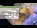 MIND🤯BLOWING TOENAILS