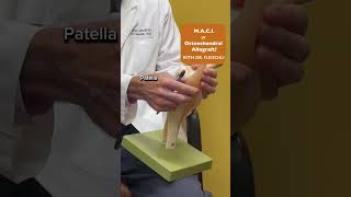 Dr. Fleischli: Solution to Knee Cartilage Damage