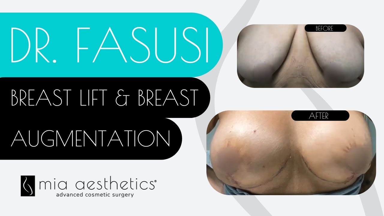 Choosing the Right Breast Implant to Achieve Your Best Results - Fiala  Aesthetics Plastic Surgery