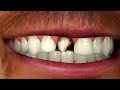 Midtown Dentistry - How to Get a Perfect Smile in Less than Three Visits