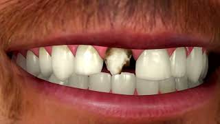 How to Get a Perfect Smile in Less than Three Visits by Dentalism 6,250 views 4 years ago 1 minute, 15 seconds