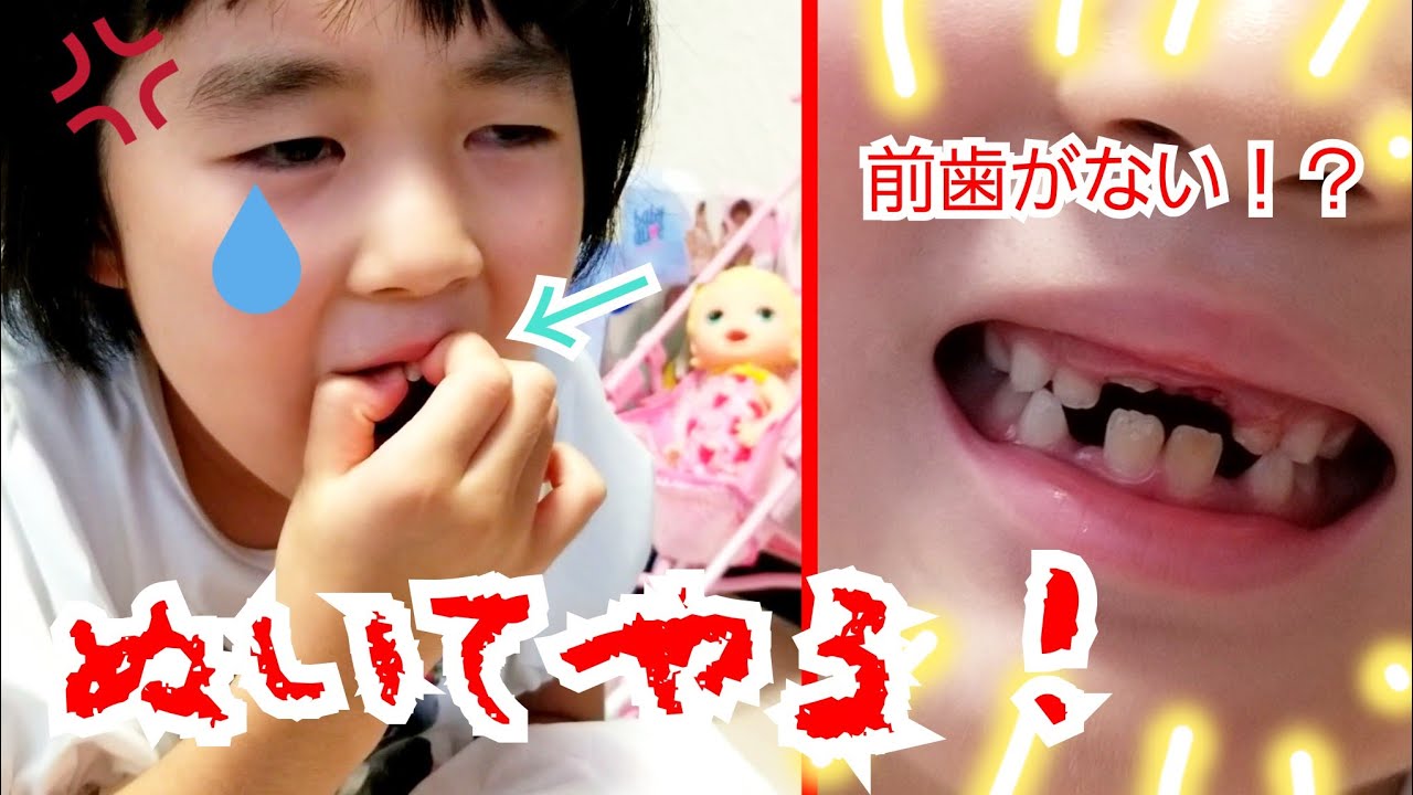 前歯がない！！自力で歯を抜いたら大変なことに！？歯が抜けた 決定的
